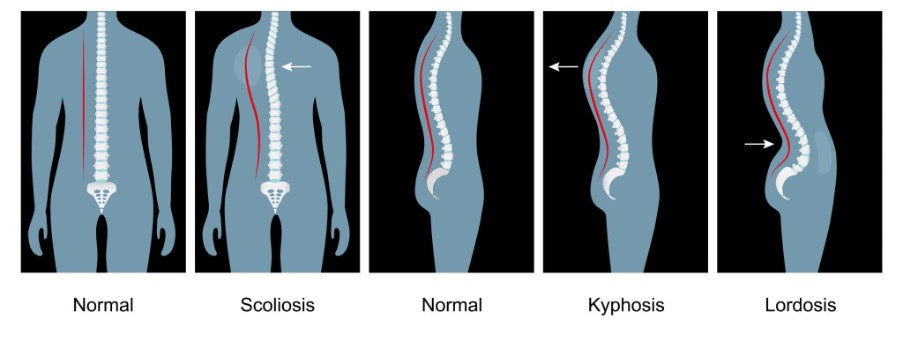 Normal spinal alignment compared with scoliosis, kyphosis and other spinal curvatures.